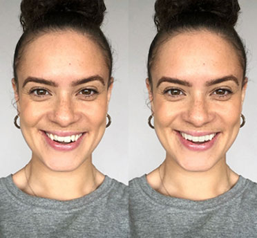 Invisalign case 3