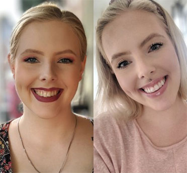 Invisalign case 2