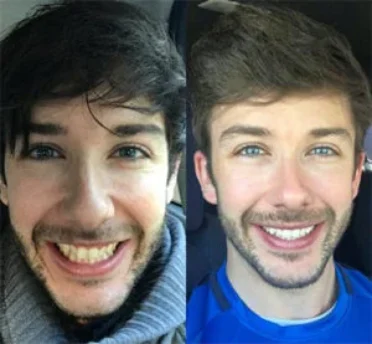 Invisalign case 1