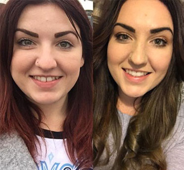 Invisalign case 4