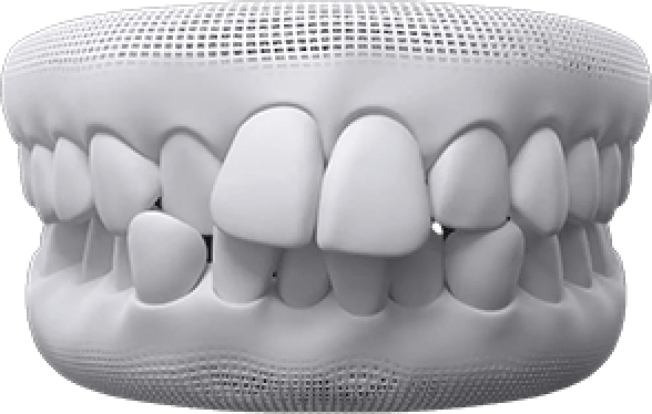 Crossbite