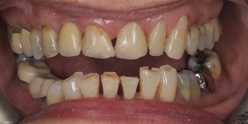 Crowns Case 1 before