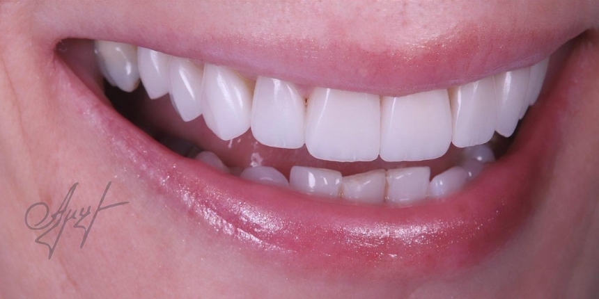 Veneers Case 3 after