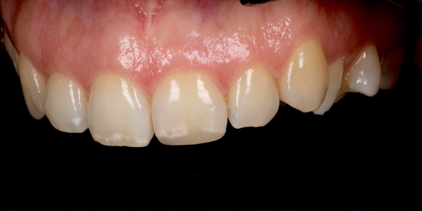 Composite Bonding Case 6 before