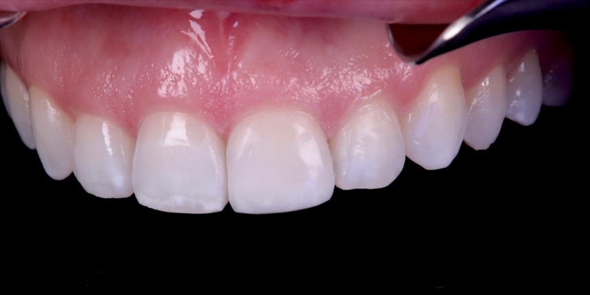 Composite Bonding Case 6 after