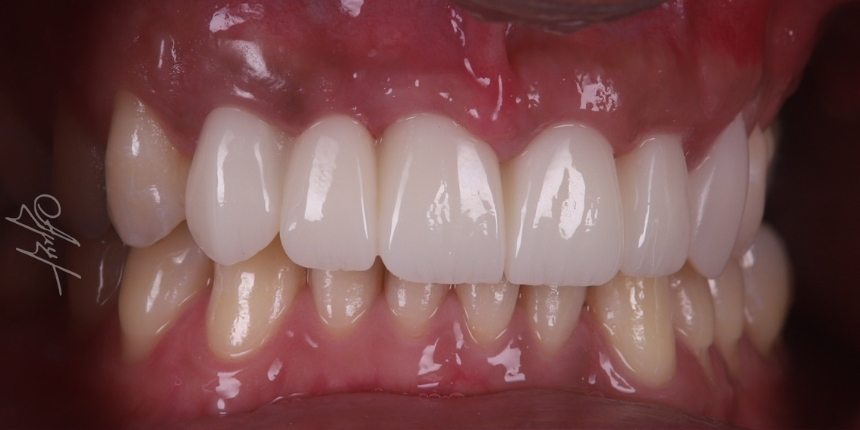 Dental Implant Case 14 after
