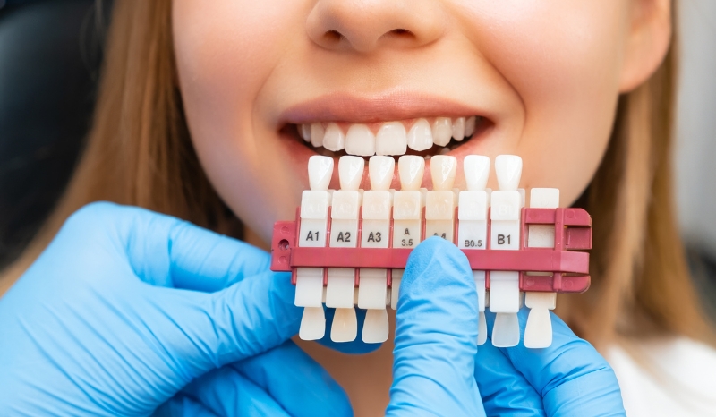 Teeth whitening in Forest Hill, Lewisham, and beyond