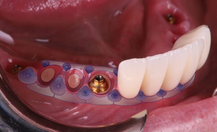 Peri-implant tissue management