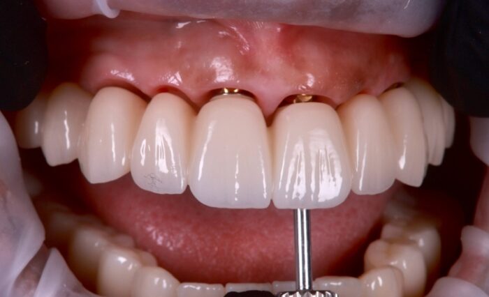 Modern Full Arch Implantology & FP1 Prosthetics 24th and 25th of January 2026