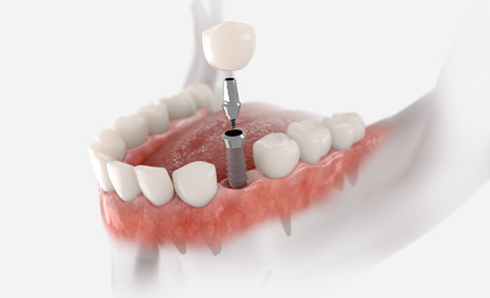 Blog - London Dental Arts