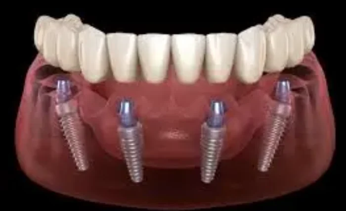 Blog - London Dental Arts